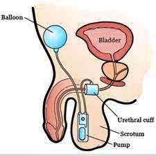 esfíncter artificial masculino