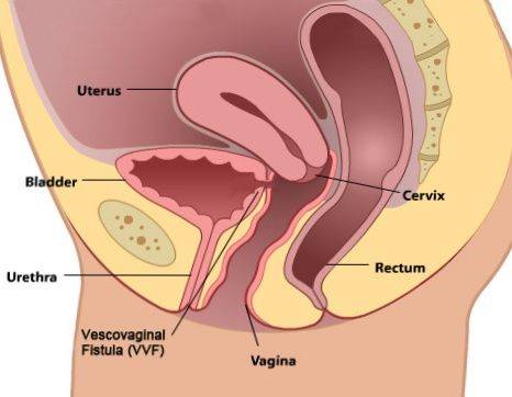 Fístula urinária